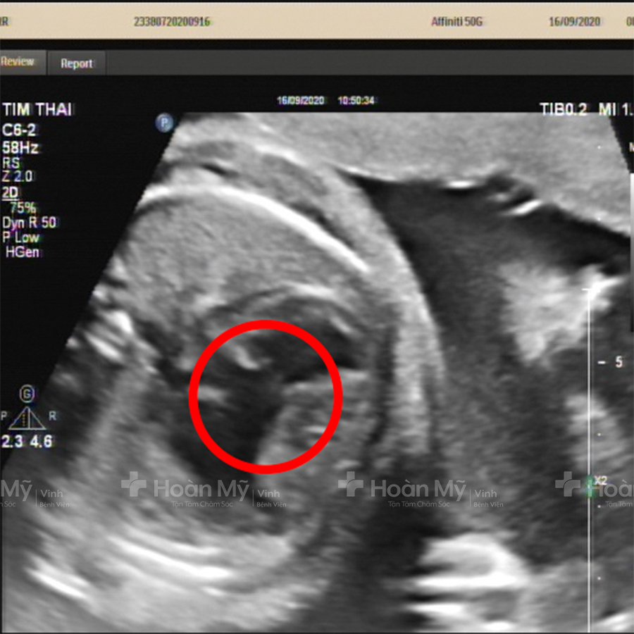 Siêu âm khó phát hiện được thai 4 tuần. (Ảnh: Sưu tầm Internet)