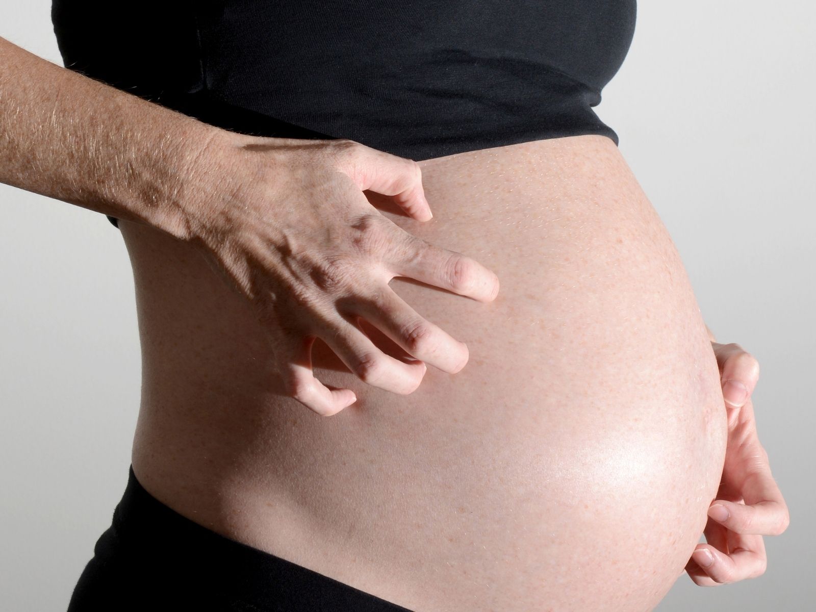 Hiện tượng viêm da. (Ảnh: Sưu tầm Internet)