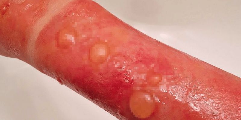 Bỏng điện cấp độ 2 có những biểu hiện nào (Ảnh: sưu tầm Internet)