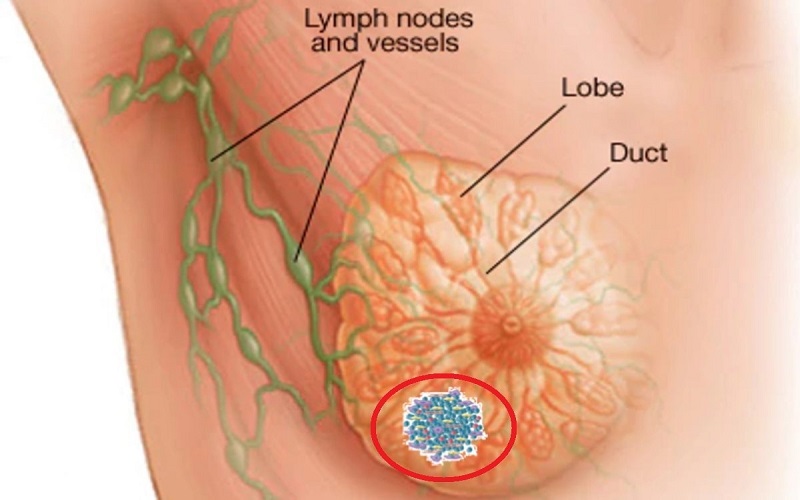 Ung thư vú thường xuất hiện dưới dạng một khối u cứng (Ảnh: Sưu tầm Internet)
