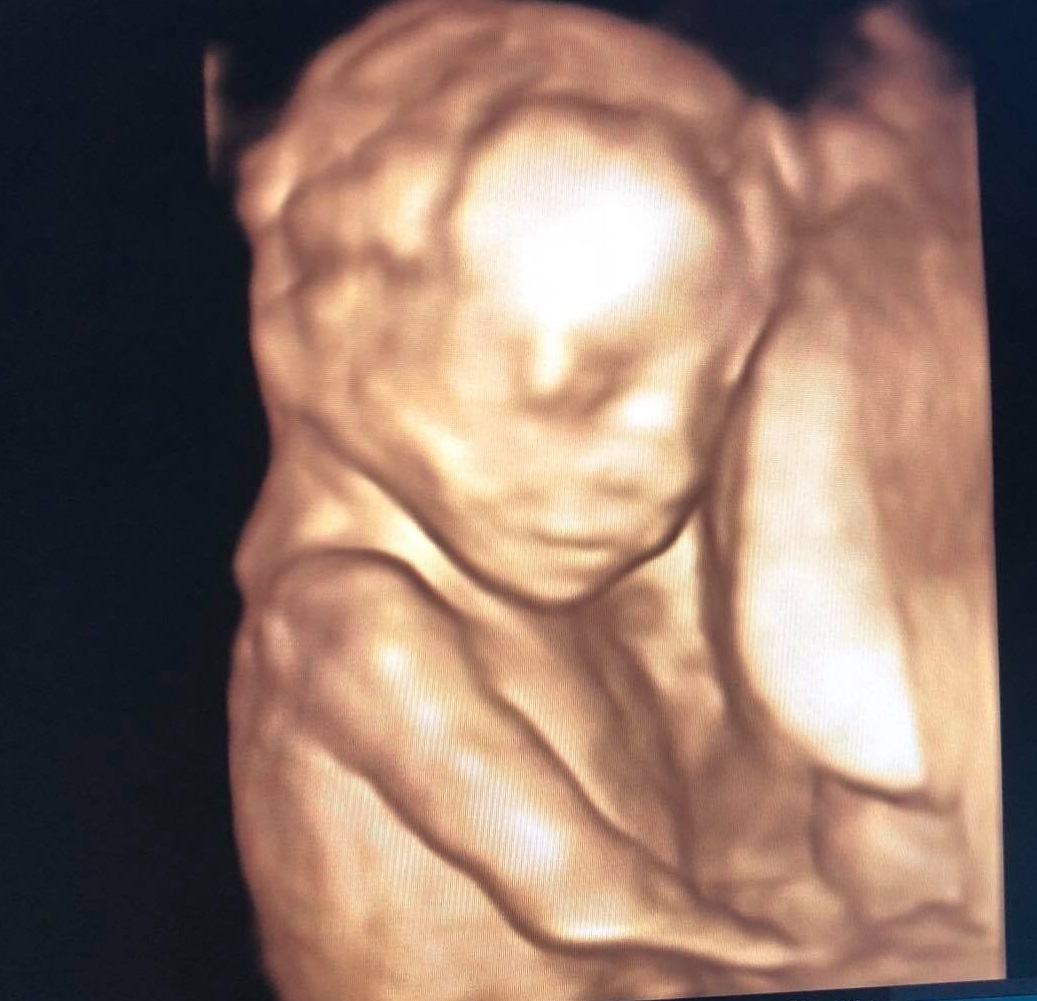 Hình ảnh siêu âm thai 19 tuần tuổi. (Ảnh: Sưu tầm Internet)