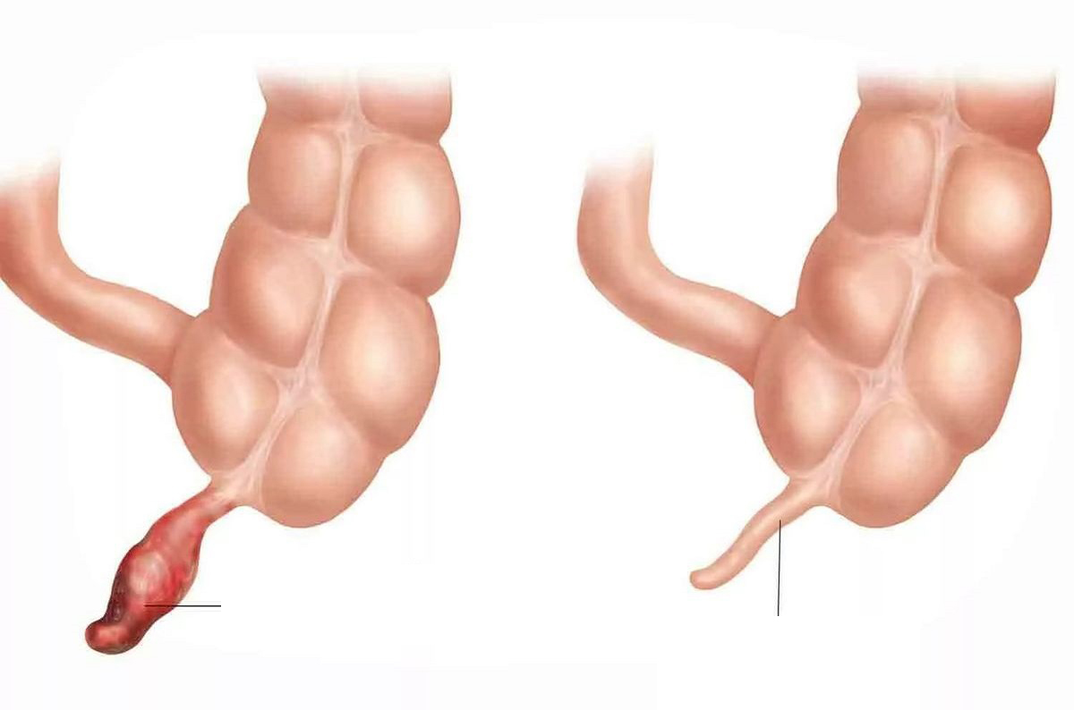 Minh họa ruột thừa bị viêm (bên trái) và ruột thừa bình thường (bên phải). (Ảnh: Sưu tầm Internet)