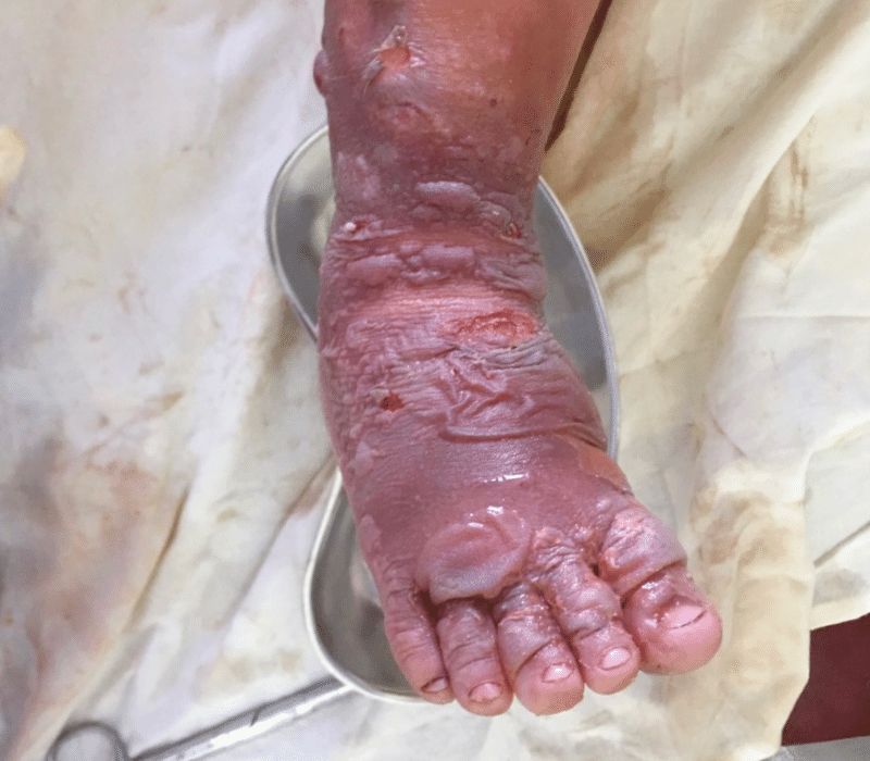 Bỏng điện cấp độ 3 có những biểu hiện nào. (Ảnh: Sưu tầm Internet)