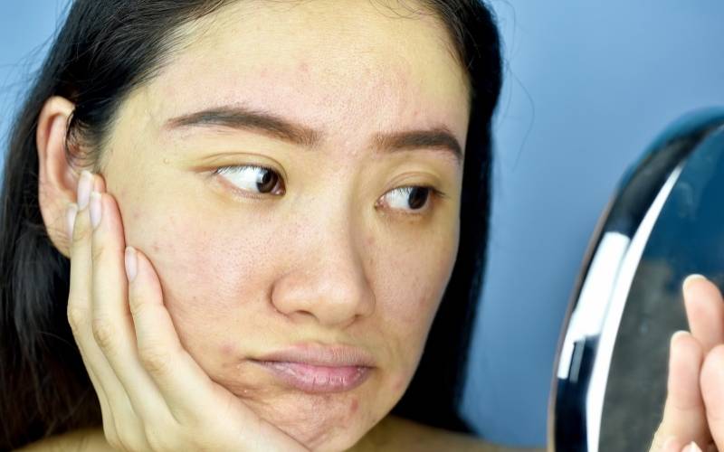 Da sạm đen, nổi mụn khi mang thai. (Ảnh: Sưu tầm Internet)