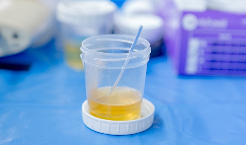 Hiện tượng Protein trong nước tiểu là gì? (Ảnh: Sưu tầm Internet)