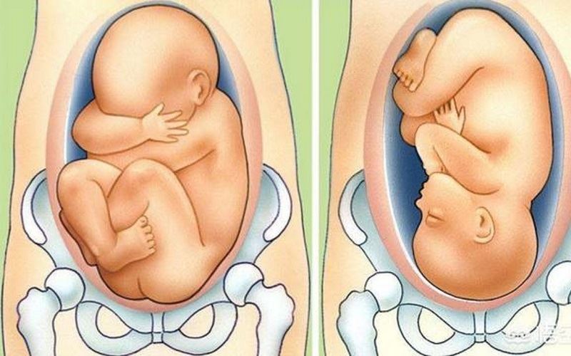 Thai nhi quay đầu mẹ có nên tiếp tục đi bộ? (Ảnh: Internet)