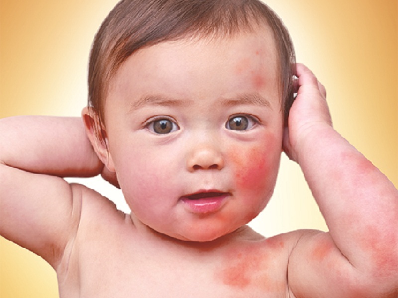 Phát ban da là một trong những dấu hiệu dị ứng thức ăn ở bé. (Ảnh: Zingnews.vn)