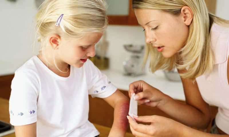 Không được chọc vỡ bóng nước khi trẻ bị bỏng bô xe máy (Nguồn: Sưu tầm internet)