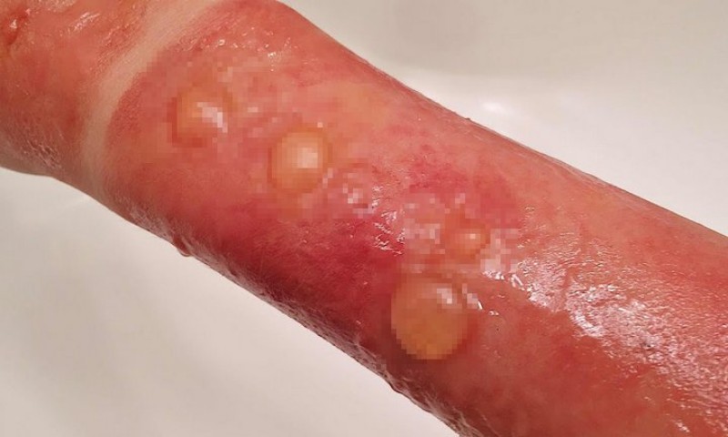 Triệu chứng khi bé bị bỏng độ 2 bên trong lớp hạ bì (Nguồn: Sưu tầm internet)