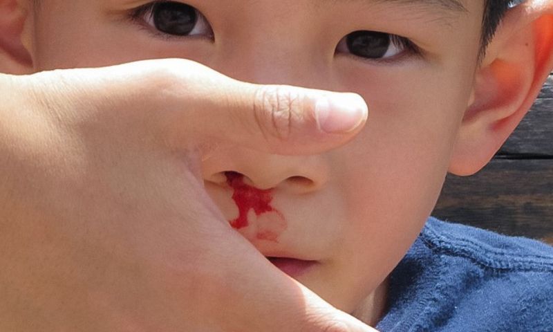 Chảy máu mũi trước chiếm phần lớn trong các ca chảy máu mũi. (Ảnh:  Nguồn Internet)