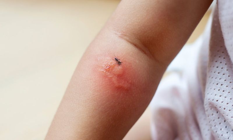 Xử lý đúng cách khi trẻ bị côn trùng đốt. (Ảnh: Nguồn Internet)