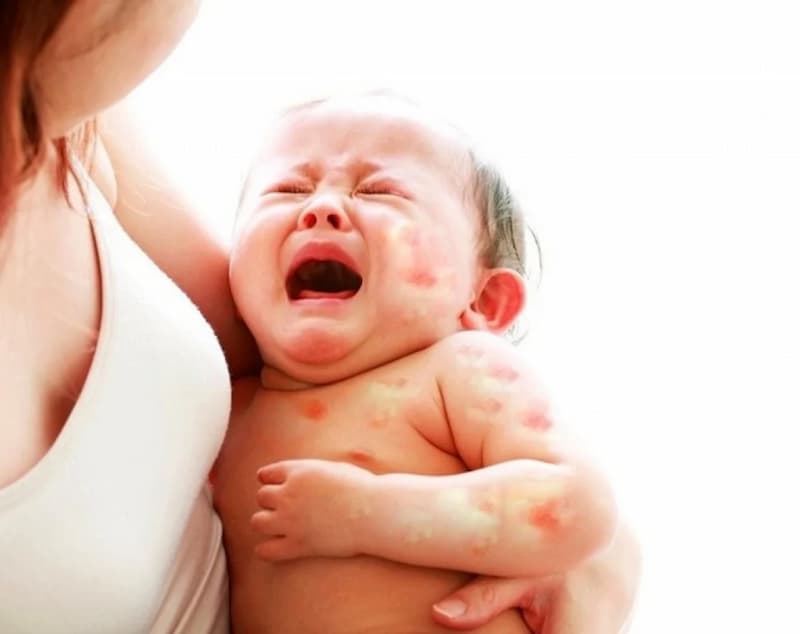 Bệnh sốt phát ban thường gặp ở trẻ. (Ảnh: sưu tầm internet)