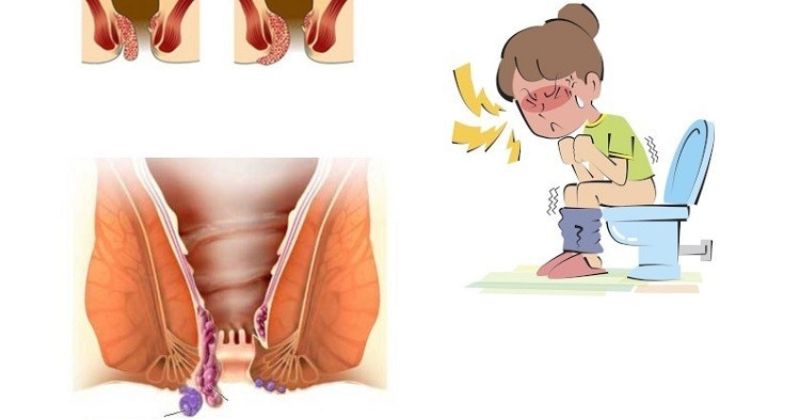 Một số dấu hiệu cảnh báo mẹ mang thai bị trĩ (Ảnh: Sưu tầm Internet)