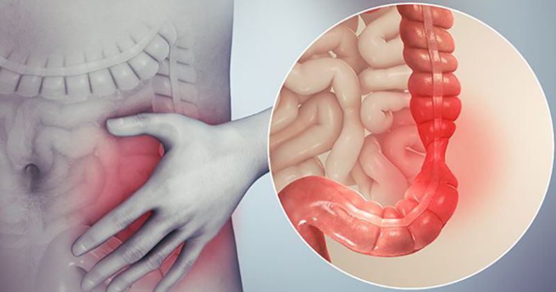 Viêm đại tràng là một dấu hiệu cảnh báo bệnh trĩ ở mẹ sau sinh (Ảnh: Sưu tầm Internet)