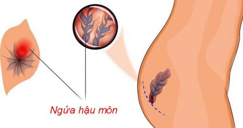 Người bị trĩ thường có biểu hiện ngứa hậu môn (Ảnh: Sưu tầm Internet)