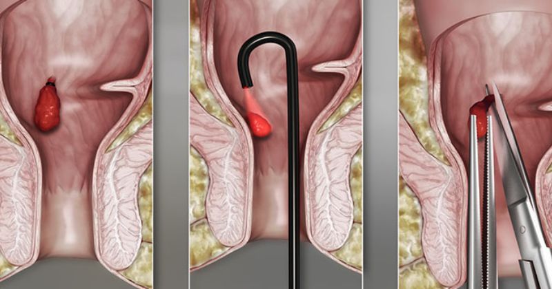 Sa búi trĩ cảnh báo cấp độ bệnh trĩ nặng (Ảnh: Sưu tầm Internet)