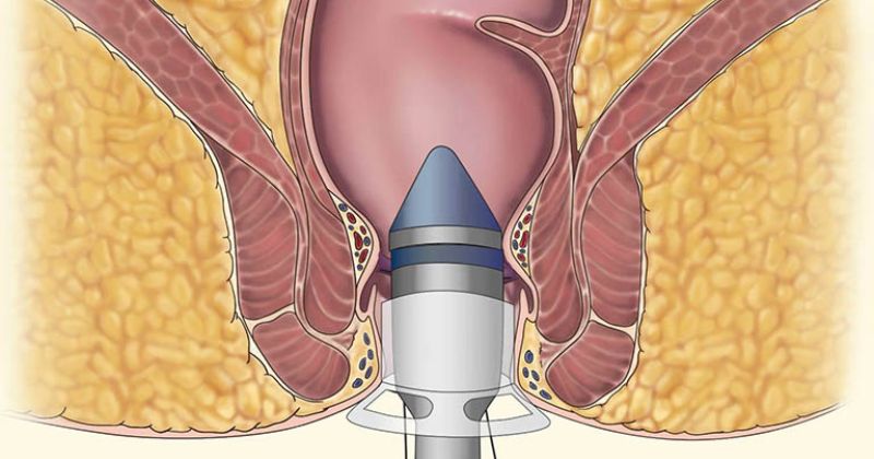 Phương pháp thủ thuật Longo chữa bệnh trĩ hiệu quả (Ảnh: Sưu tầm Internet)