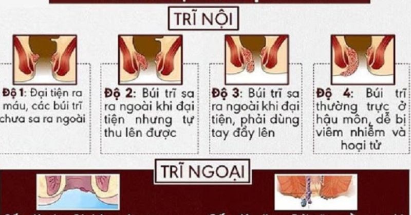 Bệnh trĩ chia ra 4 cấp độ khác nhau (Ảnh: Sưu tầm Internet)