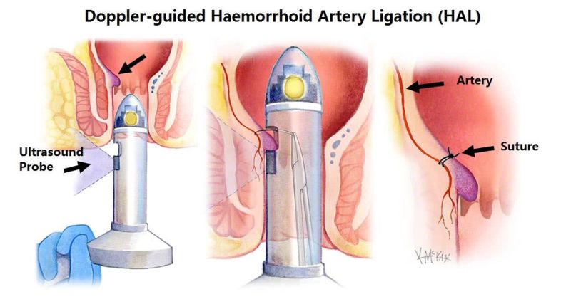 Mẹ sau sinh mổ có thể thực hiện cắt trĩ từ 2 đến 3 tháng sau sinh (Ảnh: Sưu tầm Internet)