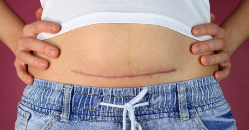 Thay băng vệ sinh mỗi 3 - 4 tiếng một lần. (Nguồn: Sưu tầm Internet)