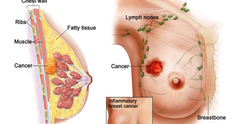 Các bệnh viêm tuyến vú, áp xe ảnh hưởng đến việc tiết sữa. (Ảnh: Sưu tầm Internet)
