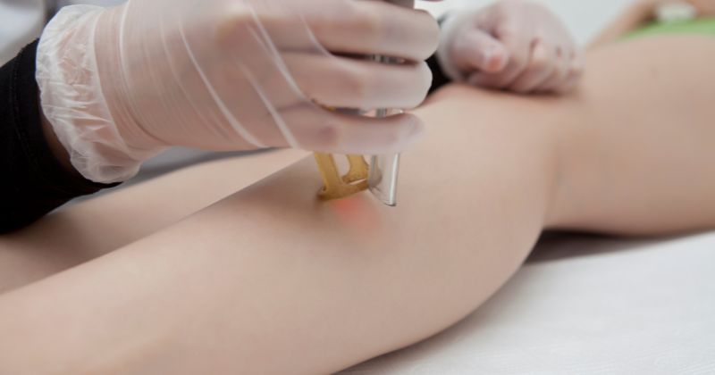 Trị rạn da bằng tia laser (Ảnh: Sưu tầm Internet)