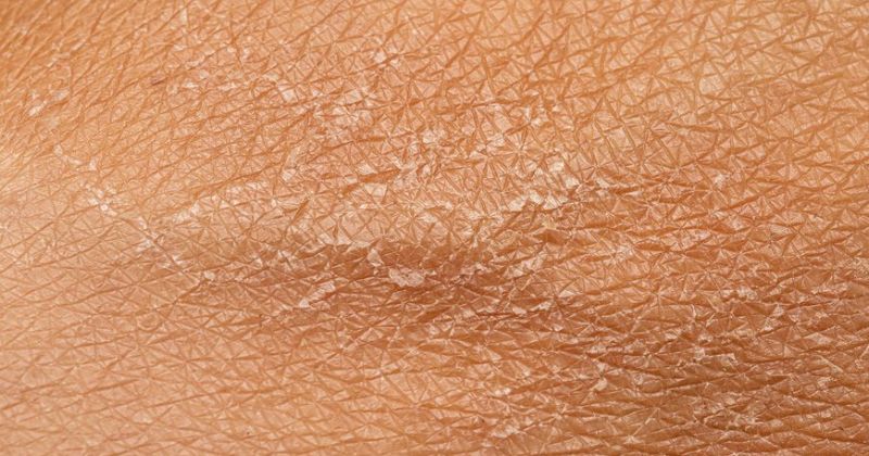 Do khô, thiếu dưỡng chất khiến cấu trúc collagen dưới da suy yếu (Ảnh: Sưu tầm Internet)