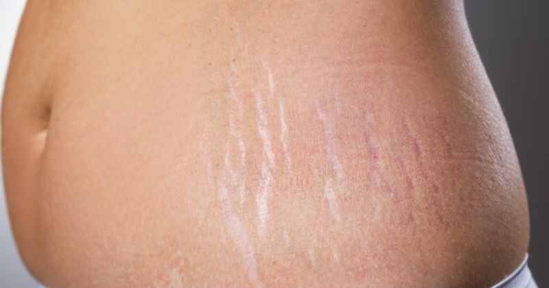 Di truyền cũng là nguyên nhân khiến mẹ bị rạn sau sinh (Ảnh: Sưu tầm Internet)