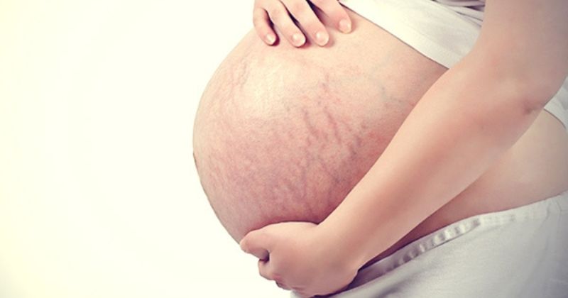 Rạn da sau khi sinh khó cải thiện và khắc phục 100% (Ảnh: Sưu tầm Internet)