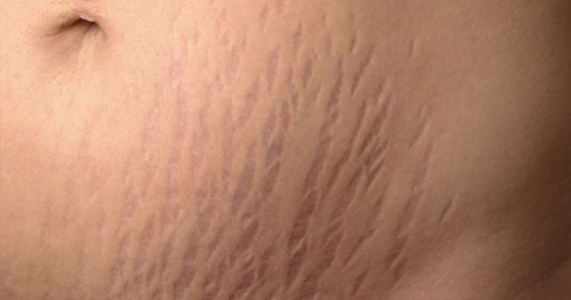 Một số lưu ý khi trị rạn mẹ không thể quả qua (Ảnh: Sưu tầm Internet)