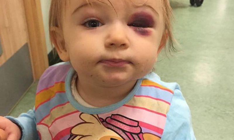 Cha mẹ cần đưa trẻ đi cấp cứu khi thấy bé bị bầm mắt và sau tai. (Ảnh: Nguồn Internet)