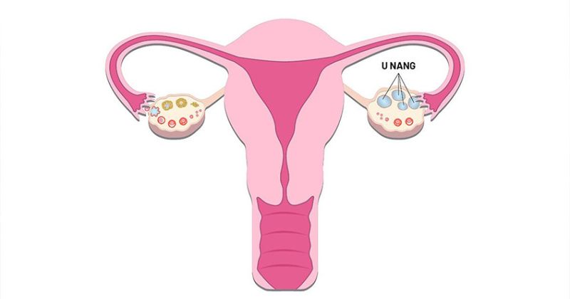 Châm kinh có thể dẫn đến hội chứng buồng trứng đa năng (Ảnh: Sưu tầm Internet)