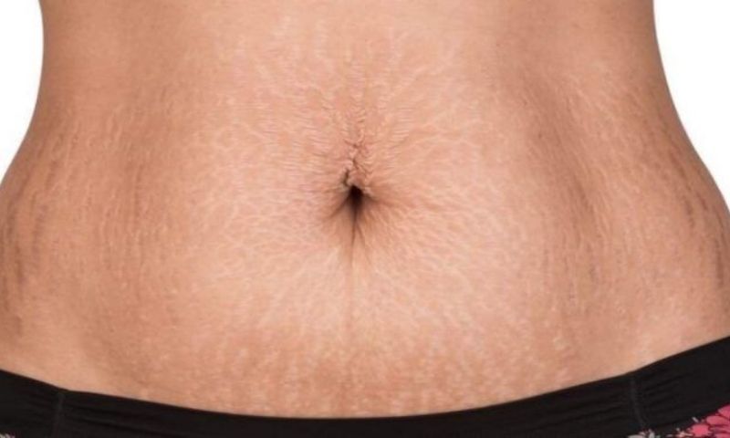 Lưu ý chăm sóc bụng sau khi sinh mổ. (Ảnh: Nguồn Internet)