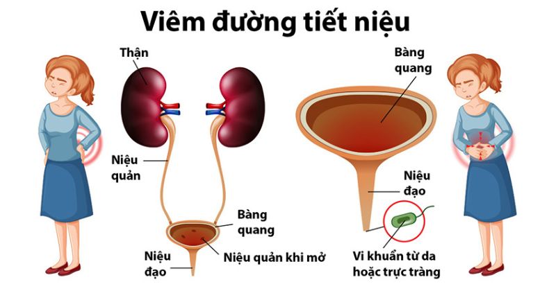 Bệnh lý này có thể gây ra viêm nhiễm phụ khoa (Ảnh: Sưu tầm Internet)