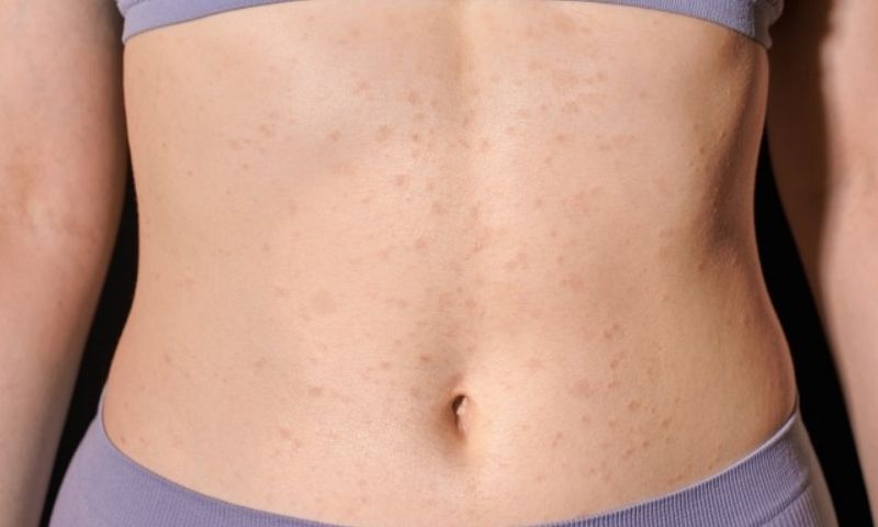 Đai nịt bụng cọ sát và bí mồ hôi gây dị ứng, mẩn đỏ.  (Ảnh: Sưu tầm Internet)