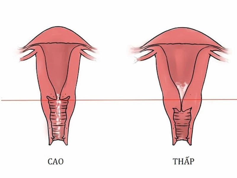 Người mẹ có cổ tử cung ngắn cần kiêng quan hệ trong thai kỳ. (Ảnh: Internet)