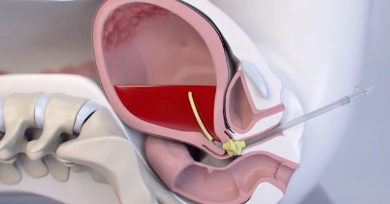 Tử cung to bất thường cảnh báo băng huyết (Ảnh: Sưu tầm Internet)