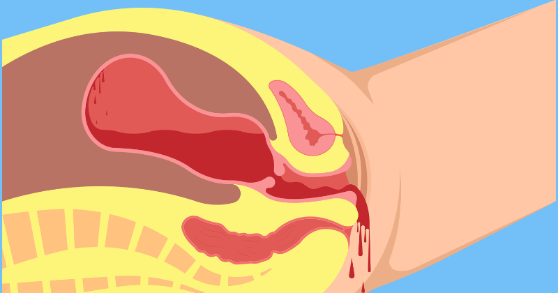 Chảy máu tử cung sau sinh cảnh báo dấu hiệu băng huyết (Ảnh: Sưu tầm Internet)