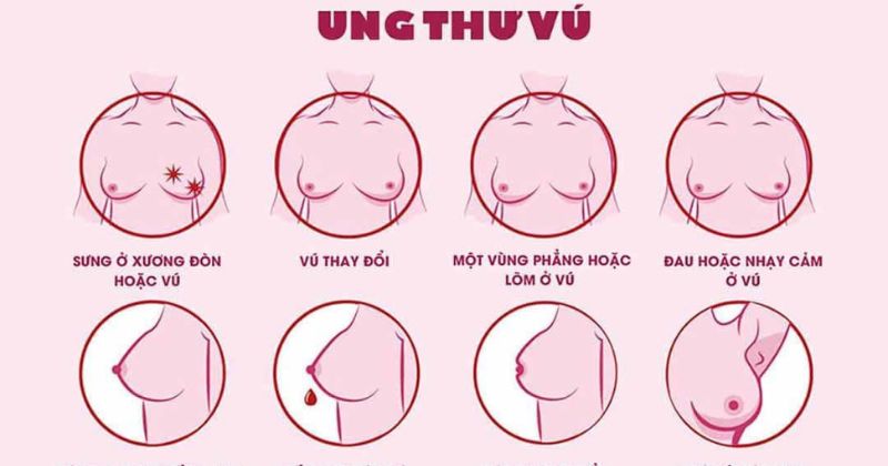 4. Khối u vú và các biến chứng tiềm tàng