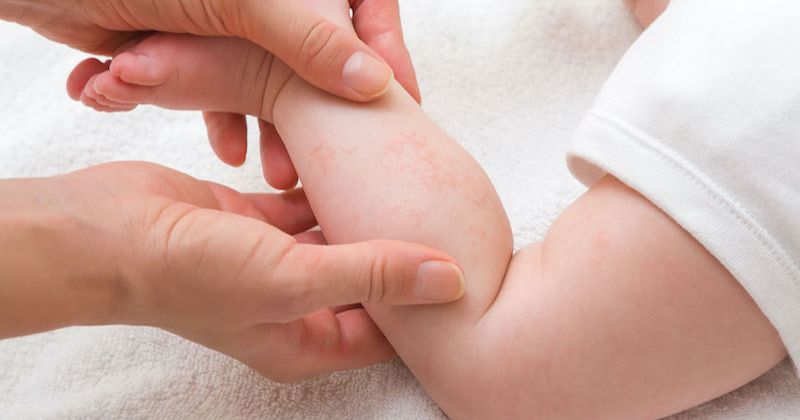 Cấp cứu hồi sức đối với trường hợp sốc phản vệ sữa. (Ảnh: Sưu tầm Internet)