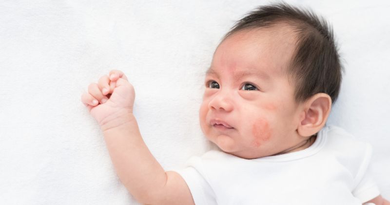 Dị ứng với sữa mẹ là tình trạng trẻ phản ứng với protein trong sữa. (Ảnh: Sưu tầm Internet)
