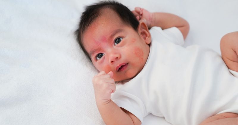 Dị ứng sữa xảy ra khi trẻ nhầm lẫn protein với kháng thể có hại. (Ảnh: Sưu tầm Internet)