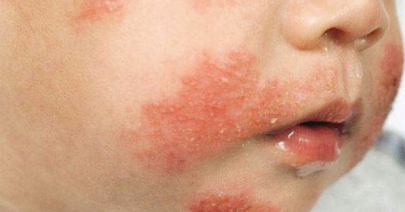 Dấu hiệu khi trẻ bị sốc phản vệ sữa mẹ. (Ảnh: Sưu tầm Internet)