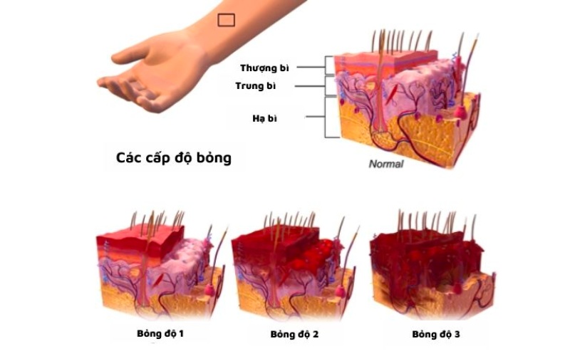 Các cấp độ bỏng khác nhau có những cách điều trị khác nhau (Ảnh: sưu tầm internet)