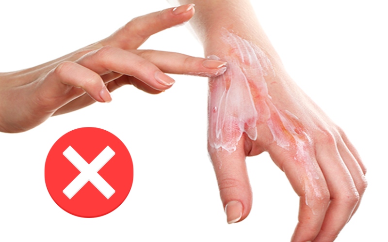 Tuyệt đối không bôi kem đánh răng lên vết bỏng để tránh nhiễm trùng (Ảnh: sưu tầm internet)