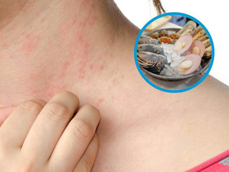 Một số triệu chứng dị ứng tôm hay gặp. (Ảnh: Sưu tầm Internet)