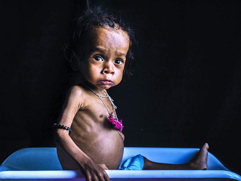 Nguyên nhân gây nên suy dinh dưỡng ở trẻ em. (Ảnh: Sưu tầm Internet)