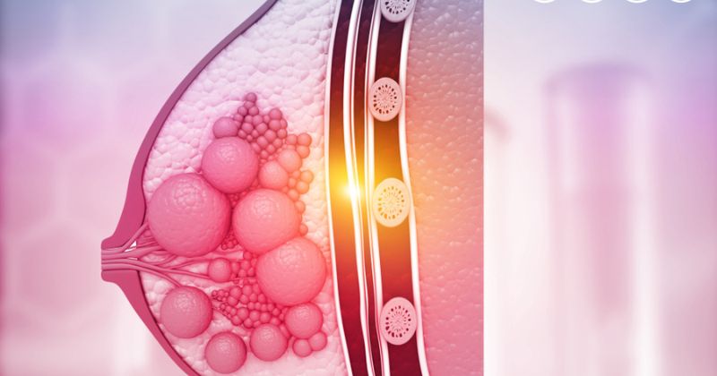 U nhú là các u lành tính xuất hiện bên trong ống dẫn sữa. (Ảnh: Sưu tầm Internet)