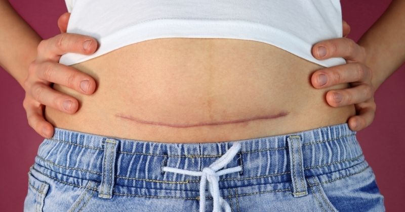 Sau sinh mổ lần 2 mẹ vẫn cần ở cữ để nhanh hồi phục sức khỏe (Ảnh: Sưu tầm Internet)