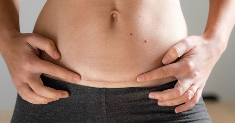 Đau vết mổ sau sinh là một lý do khiến mẹ bị căng thẳng, mất ngủ (Ảnh: Sưu tầm Internet)